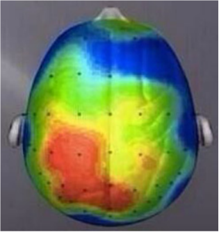 Brain after a 20 minute walk. Research/scan compliments of Dr. Charles Hillman University of Illinois.